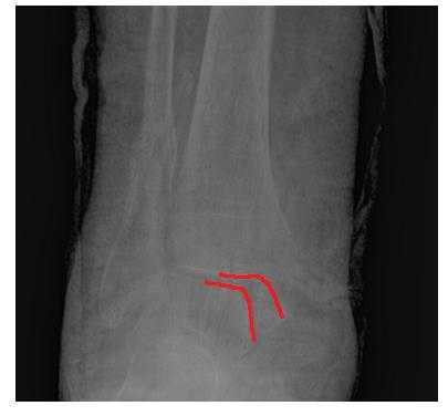 вывих стопы