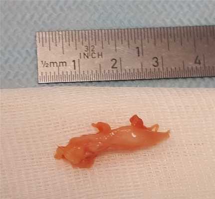 удалённая неврома мортона