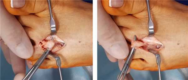 неврома мортона