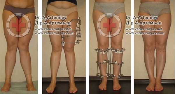 кривые ноги операция