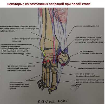 полая стопа операция