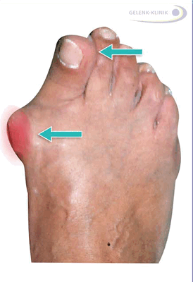 Вальгусная деформация