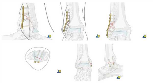 операция перелома лодыжки