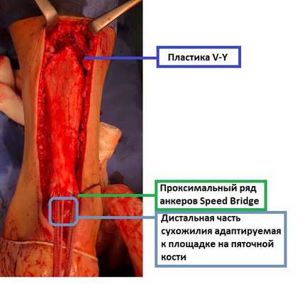 операция при отрыве ахиллова сухожилия