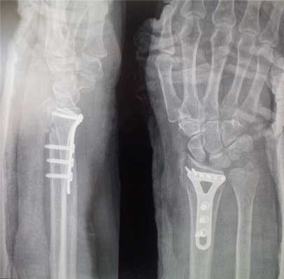 остеосинтез лучевой кости