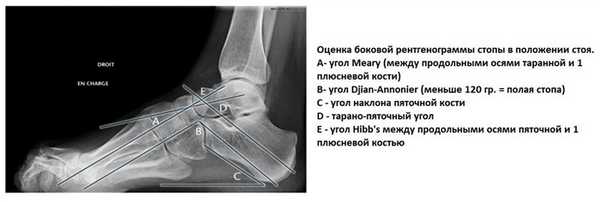 полая стопа рентген