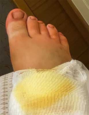 перелом лодыжек с разрывом синдесмоза