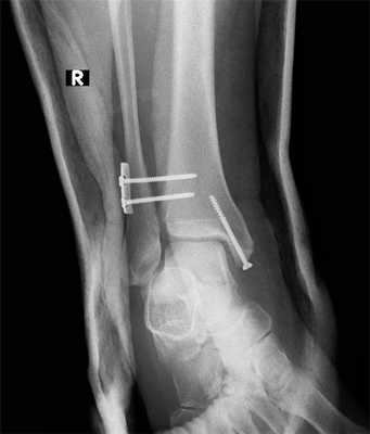 перелом лодыжек с разрывом синдесмоза операция