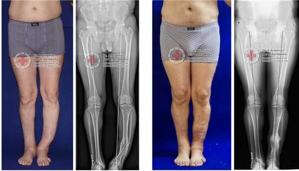 деформация ног операция