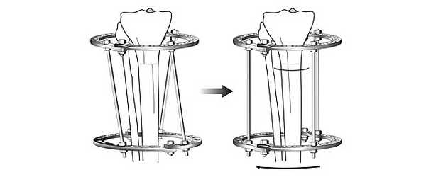 Схема ротационной коррекции в аппарате Илизарова