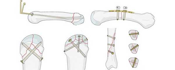 Особливості реабілітації після остеосинтезу стегнової кістки, плечової кістки та гомілки - 1