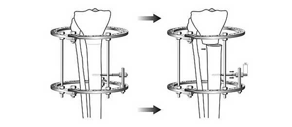 Схема медиализации большеберцовой кости