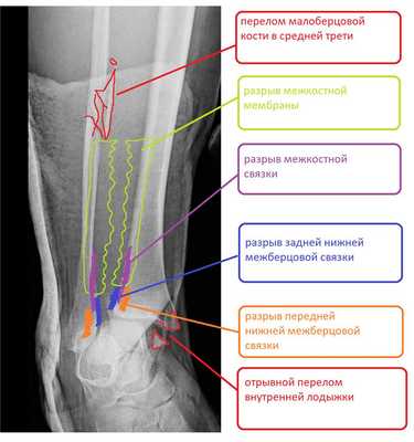 разрыв межберцового синдесмоза схема