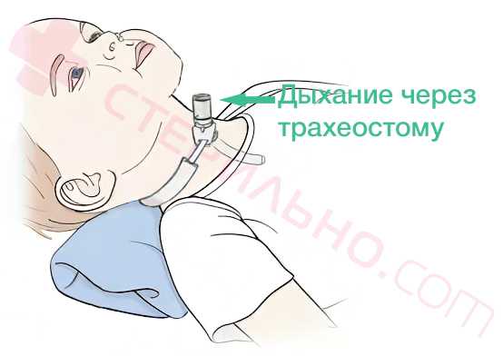 Трахеостома для детей