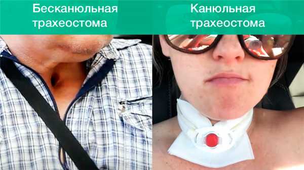 Трахеостома: постоянная или временная. Стерильно.com