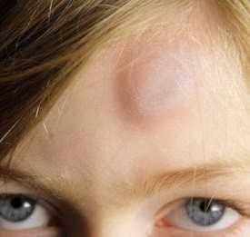 Фото Фиброма на голове