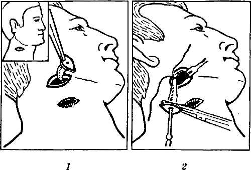 Рис. 2. Операция иссечения бранхиогенного свища шеи (вверху слева — овальный разрез кожи, включающий свищевой ход)