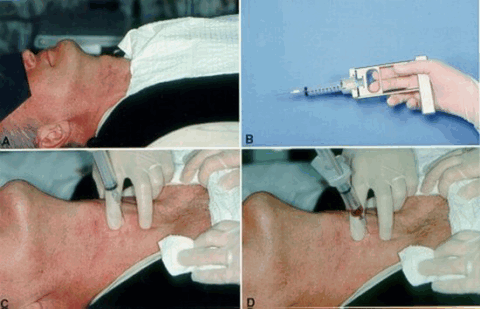 Процедура выполнения тонкоигольной биопсии (видео в этой статье).