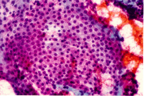 Коллоидный узелок. Оболочка нормального эпителия щитовидной железы показывает однородные ядра в цитоплазме.