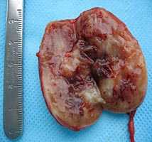 Макропрепарат параганглиомы