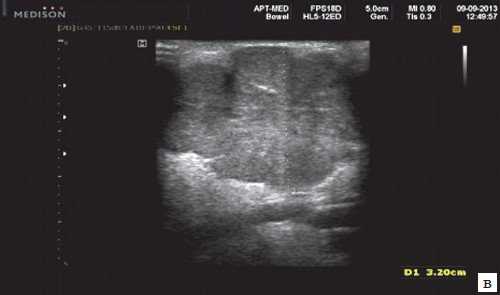 Эхограмма - плеоморфная аденома слюнных желез (в)