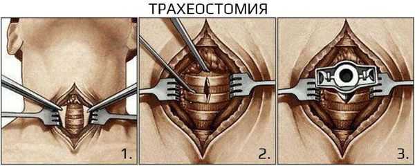 Трахеостомия