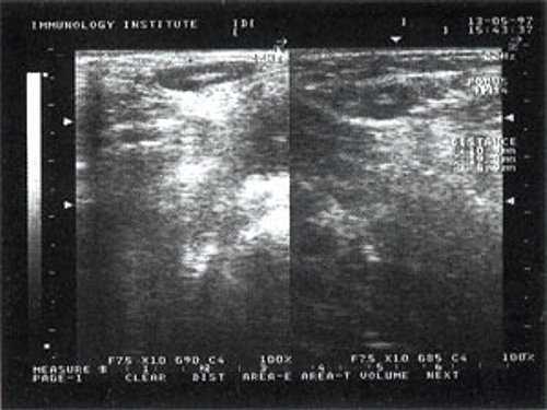 Изображение увеличенного лимфатического узла с УЗ-признаками доброкачественной аденопатии у больного с синдромом иммунодефицита (б)