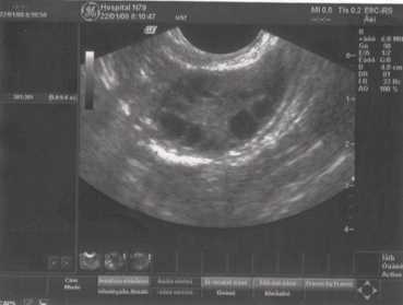 УЗИ:яичники в норме