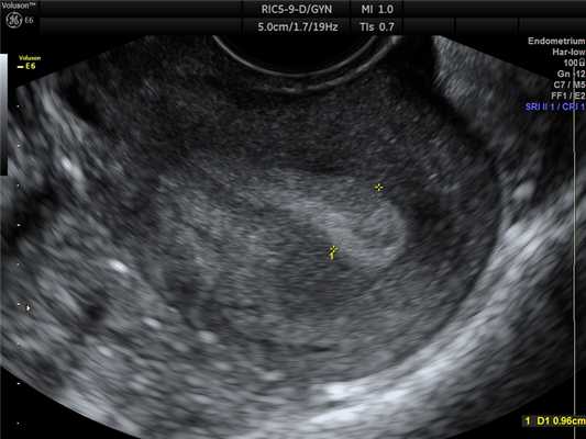 Толщина М-эхо, норма. 2Д.