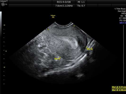 УЗИ нормальной матки. 2Д.