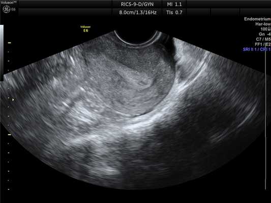 УЗИ норамльной матки. 2Д.