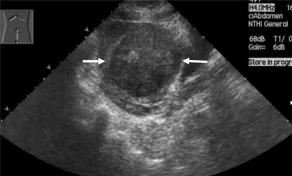 вагинальное узи матки