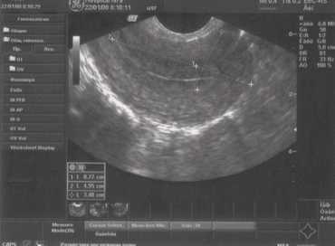 УЗИ:матка в норме