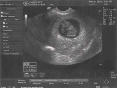 УЗИ:яичники в норме