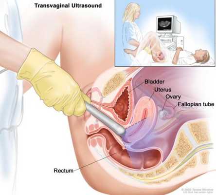 как проводится трансвагинальное узи
