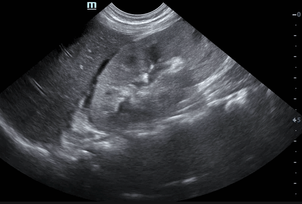 узи почек опухоли