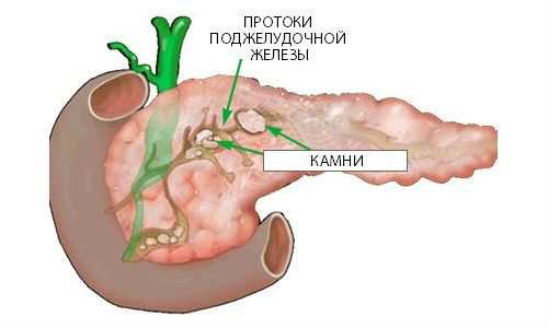 Камни поджелудочной железы