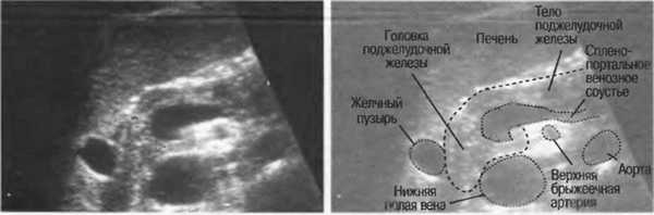 Поджелудочная железа на УЗИ