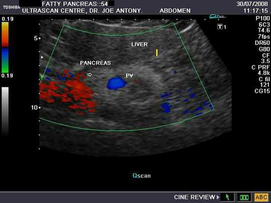 Диффузные изменения в тканях поджелудочной