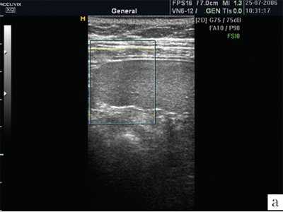 УЗИ селезенки в обычном режиме