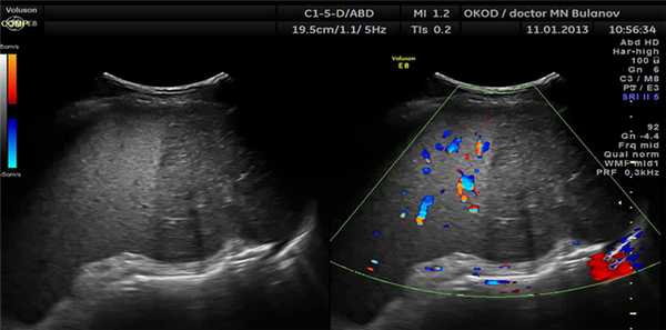 Инфаркт почти половины площади селезенки за счет тромбоза при онкологическом заболевании. УЗИ сканограмма