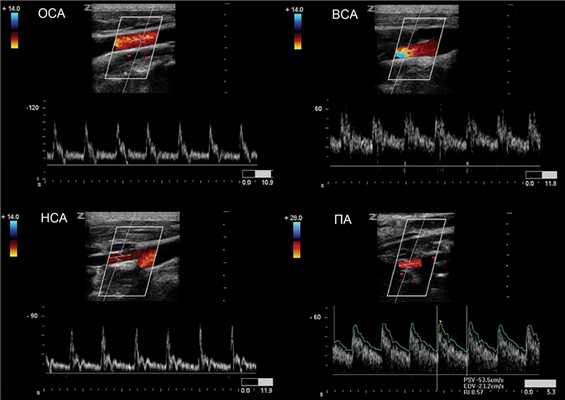 ОСА, НСА, ВСА, ПА