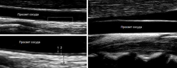 Стенка артерии