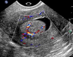 Рак на узи матки