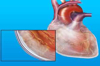 Скопление жидкости в сердце