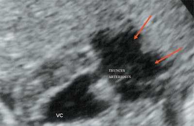 Эхограмма - общий желудочек с отхождением TRUNCUS ARTERIOSUS, стрелками показано разделение TRUNCUS ARTERIOSUS на аорту и ствол легочной артерии (VC - общий желудочек, TRUNCUS ARTERIOSUS - общий артериальный ствол)