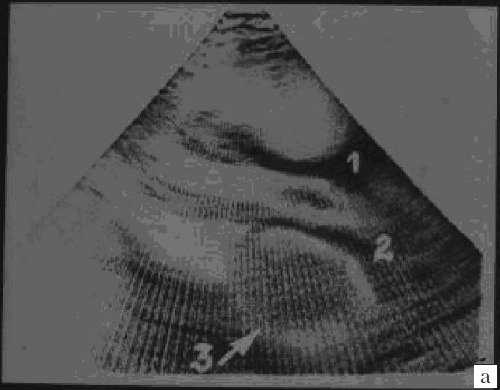Эхограмма - миксома левого предсердия: 1 и 2 - стенка аорты, 3 - миксома