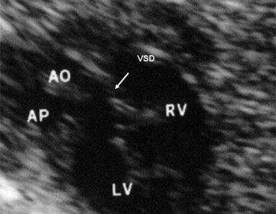 Эхограмма - двойное отхождение магистральных сосудов от левого желудочка, магистральные сосуды инвертированы и отходят от левого желудочка ). Аорта расположена