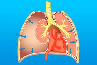 Пневмоторакс