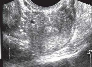 УЗИ: Ширина однорогой матки (3,4 см), поперечное трансвагинальное сканирование: 1-матка, 2-эндометрий